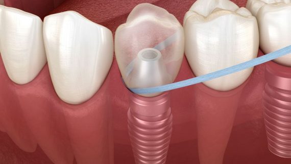 ¿Qué cuidados hay que realizar para mantener los implantes dentales?