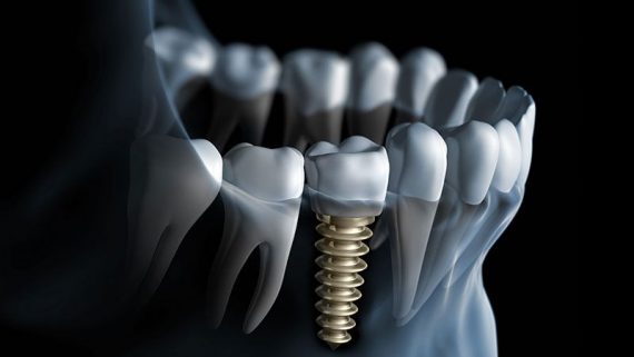 Recupera tus dientes en un día: implantes de carga inmediata