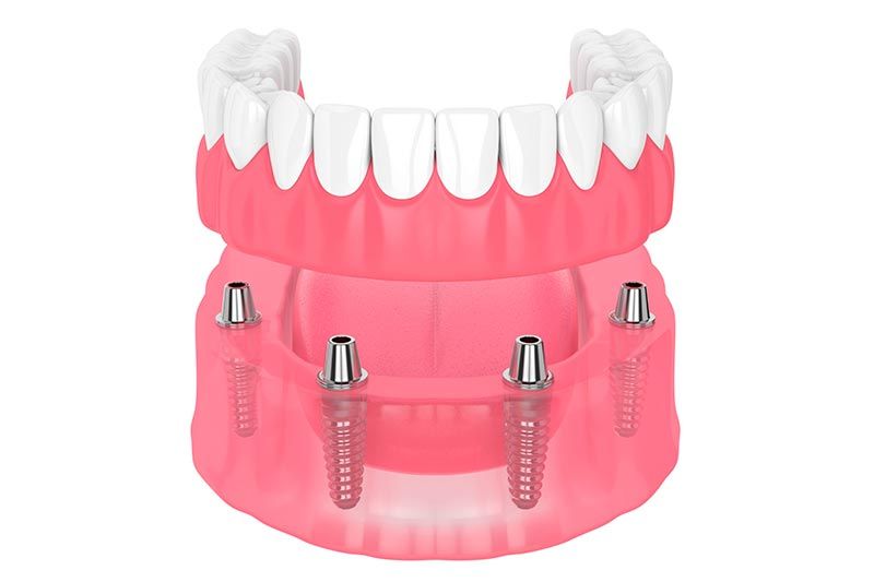 protesis-dental-completa-4-implantes
