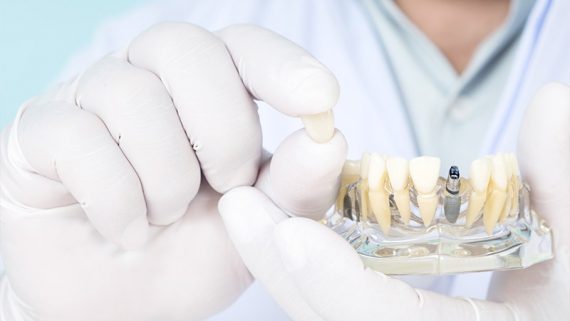 ¿Cómo se coloca un implante dental en Brånemark Las Palmas?