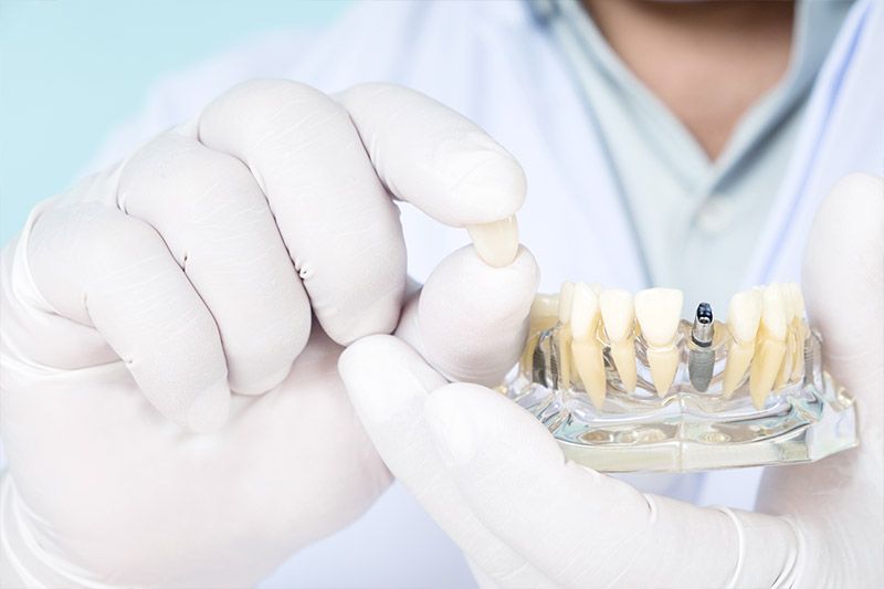 implante-dental-corona