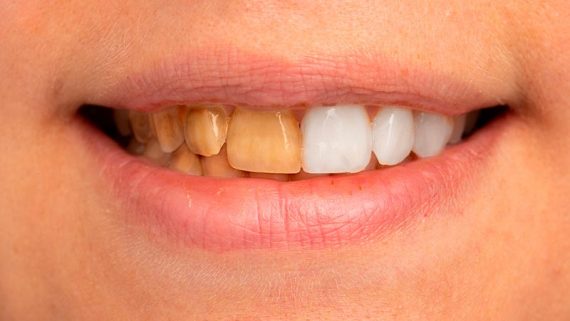 Manchas en los dientes: por qué salen y cómo eliminarlas