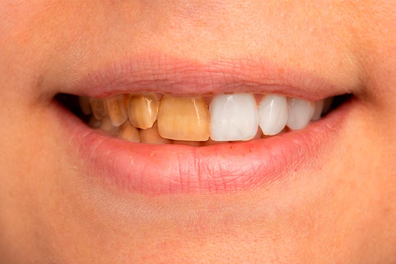 A close up view on the teeth of a young adult, half of the teeth have been whitened and half have yellow staining. Cosmetic dentistry concept.