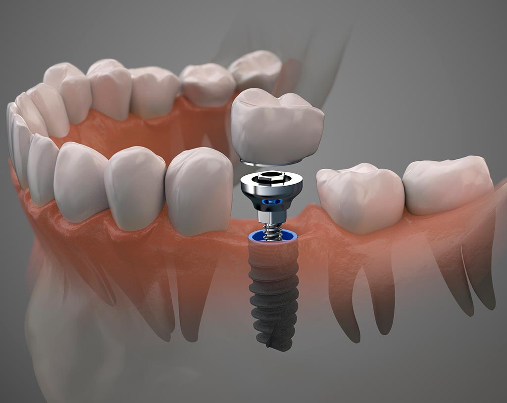 Tratamientos de implantes dentales inmediatos