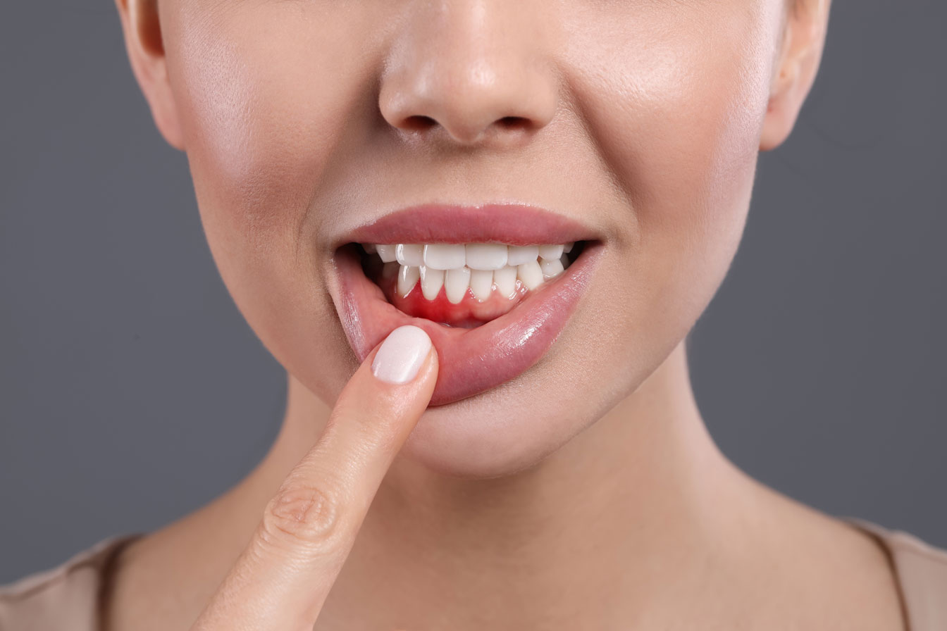 Mujer señalando sus encias inflamadas
