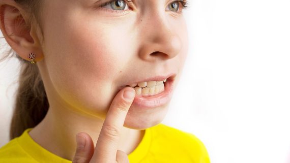 Mordida abierta. ¿Qué es y cómo corregirla?