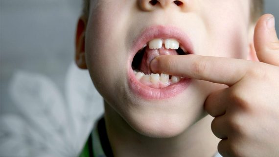 Frenillo Lingual- problemas y tratamientos