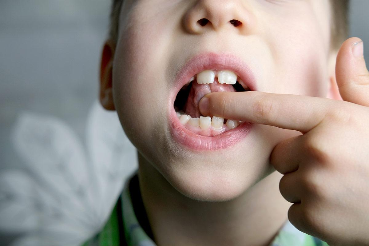 Niño tocándose frenillo lingual