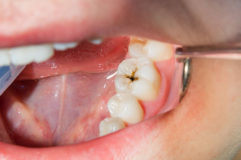 Caries
