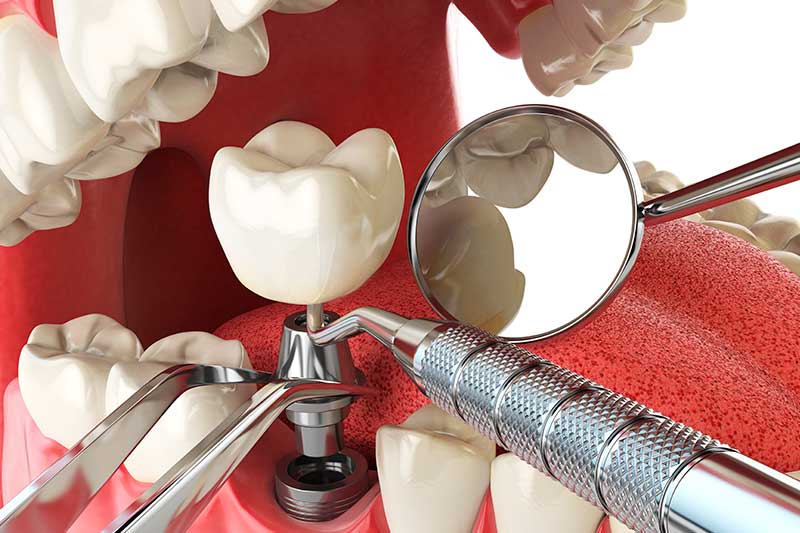 colocar-implante-dental