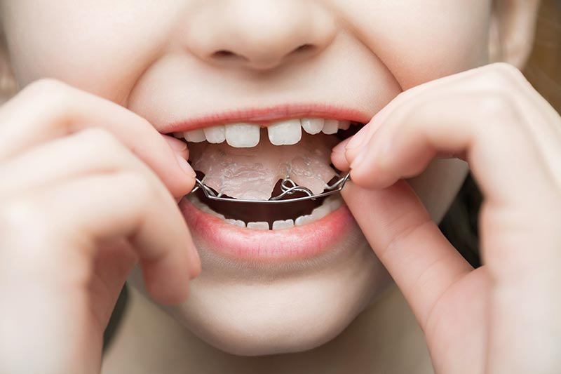 ortodoncia-interceptiva-dientes-torcidos-ninos