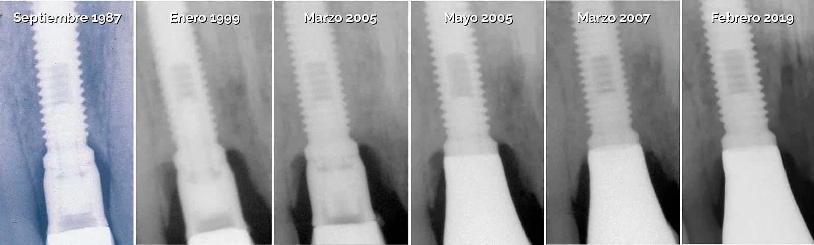 Secuencia radiográfica desde 1987 hasta 2019