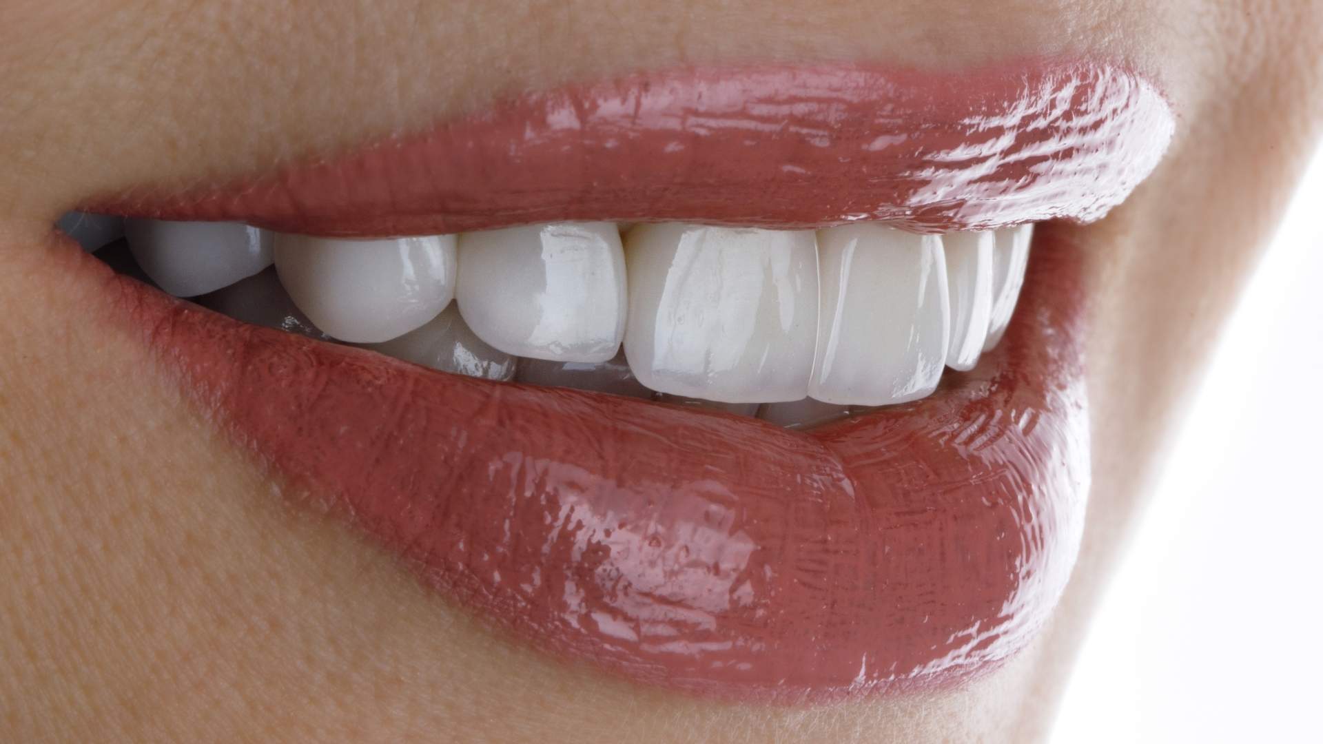 sonrisa blanca con carillas